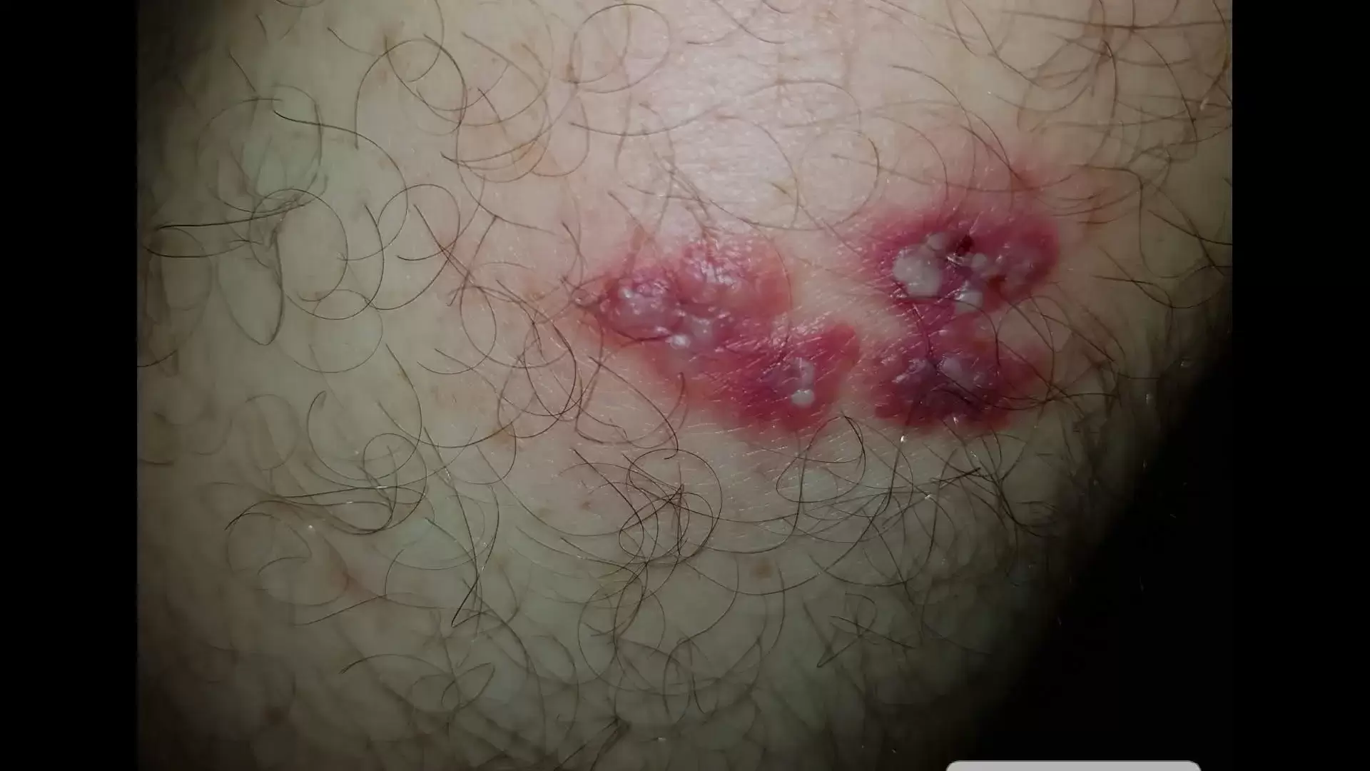 Herpes Zoster in my right leg.