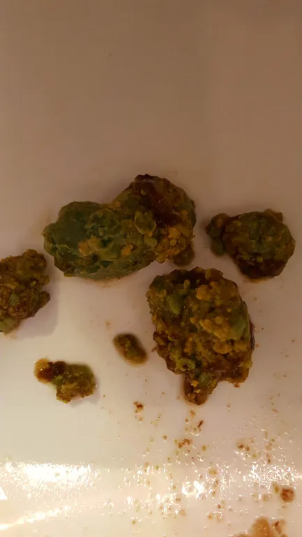 Liver solidified stones and gallstones.
