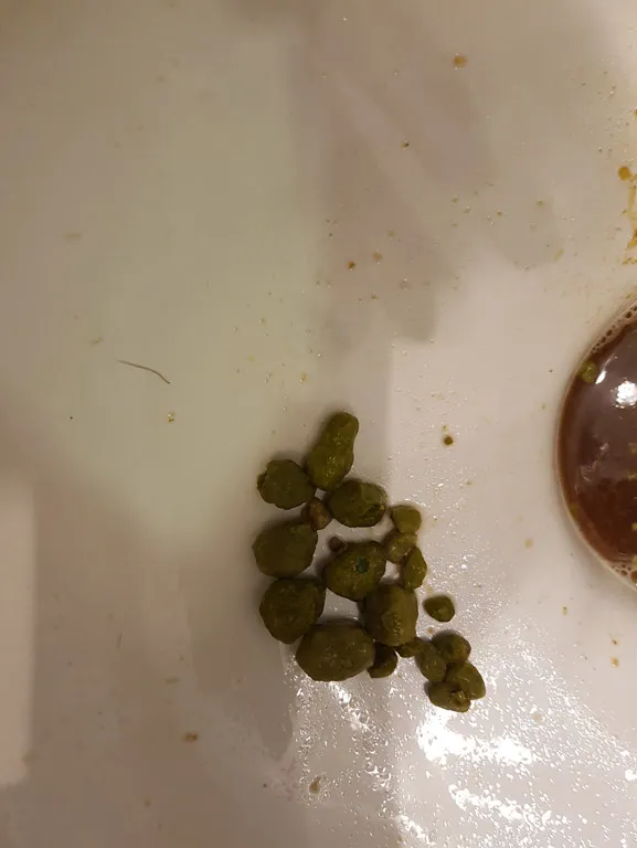 Liver solidified stones and gallstones.