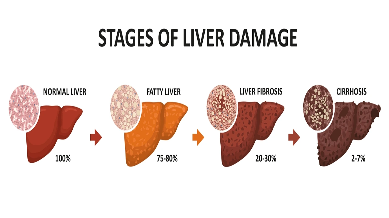 Stages of liver damage.