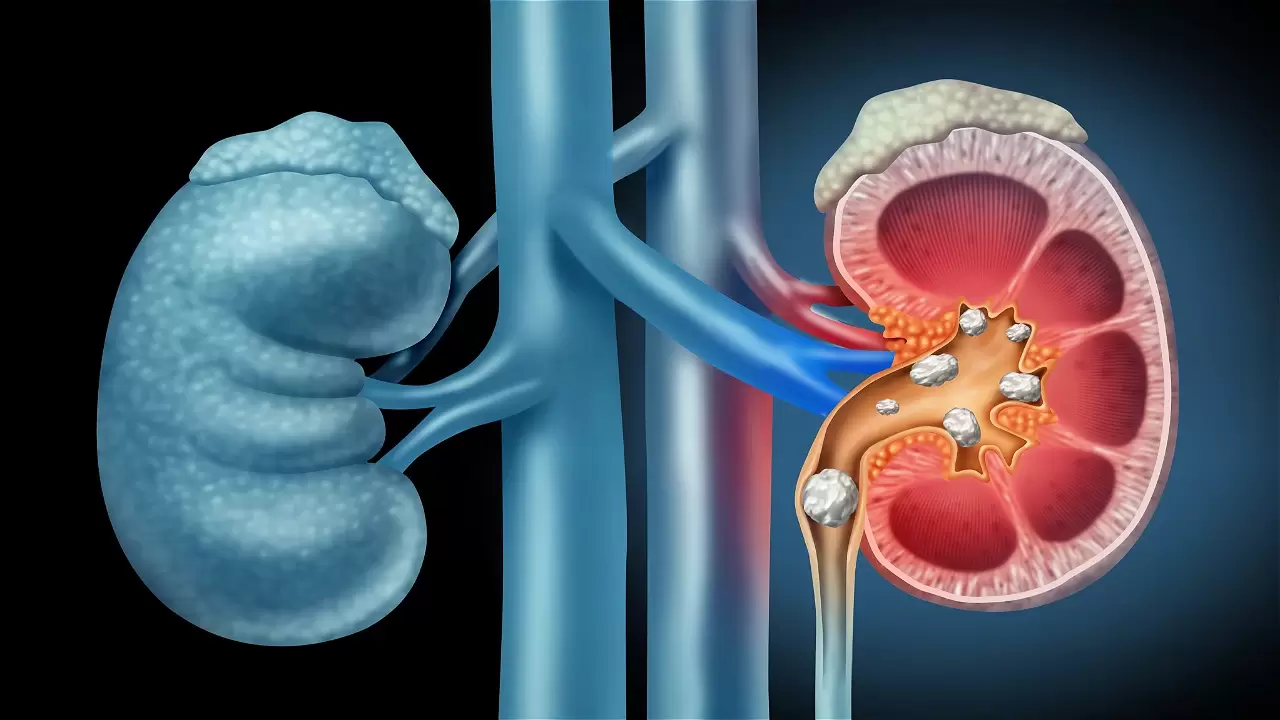 Kidney cleansing: Parsley tea, Steam sauna, Jacuzzi hot water jets.