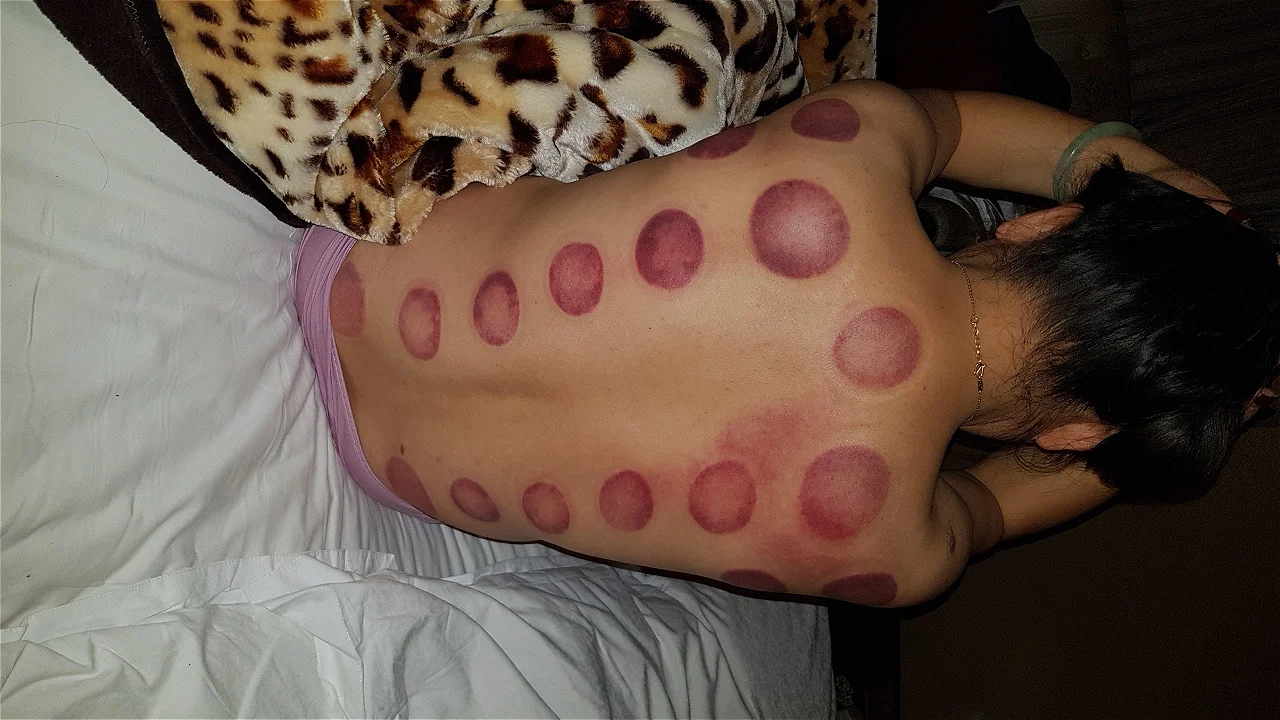 Cupping. (Traditional Chinese therapy)