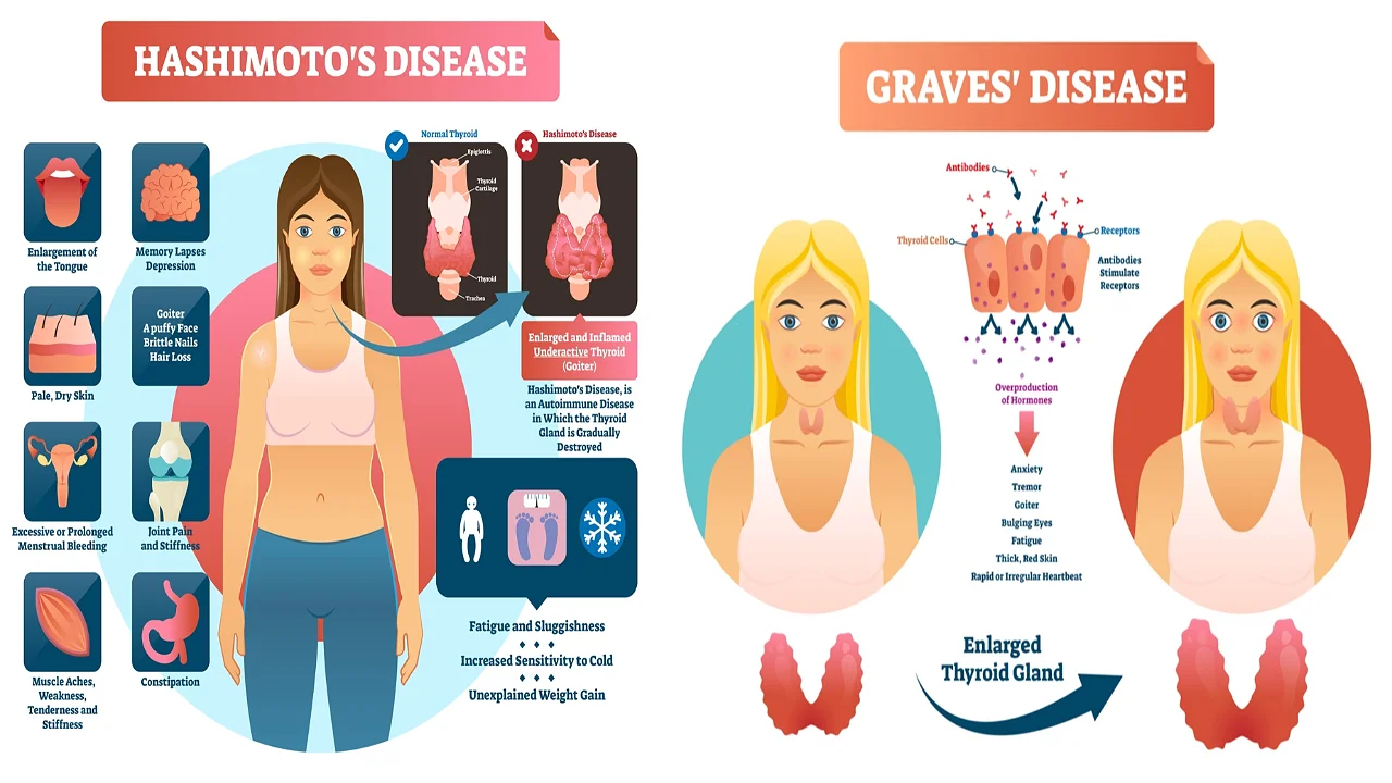 Hashimoto's and Graves' thyroid diseases.