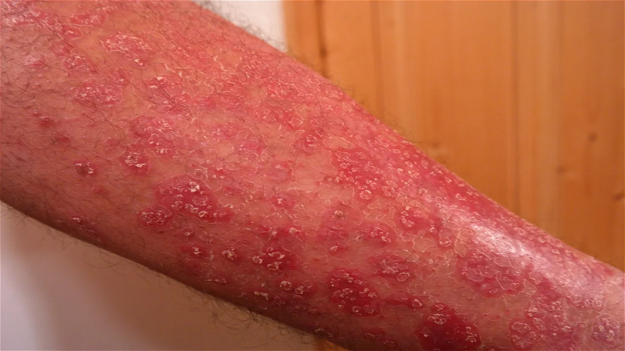 Psoriasis.