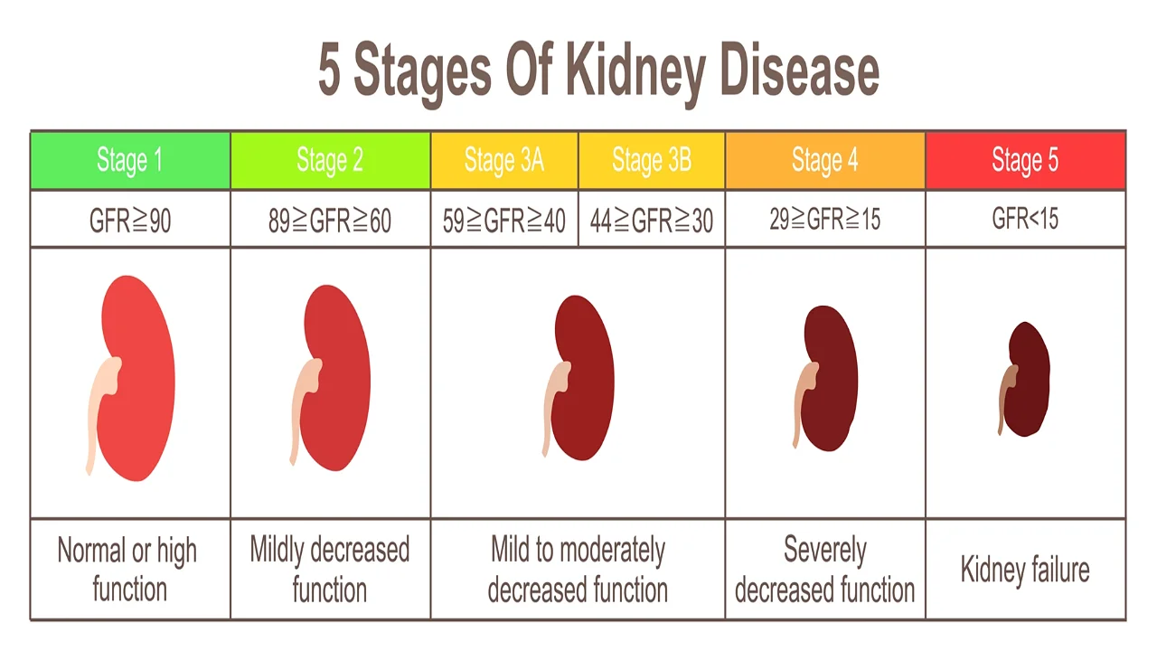 Five stages of chronic kidney disease.