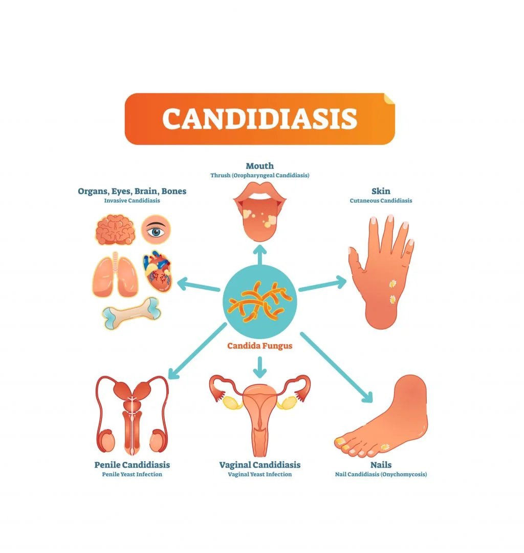 Why are recurrent fungal infections widespread in chronic patients?