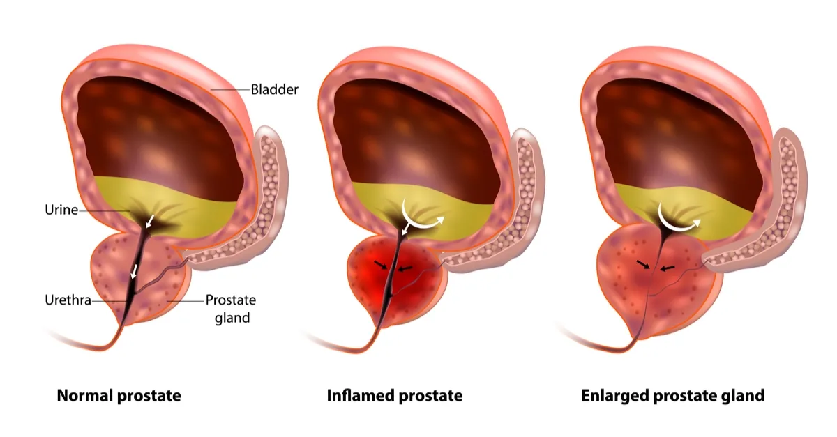 Prostate Enlargement. (Benign Prostatic Hyperplasia BPH) 