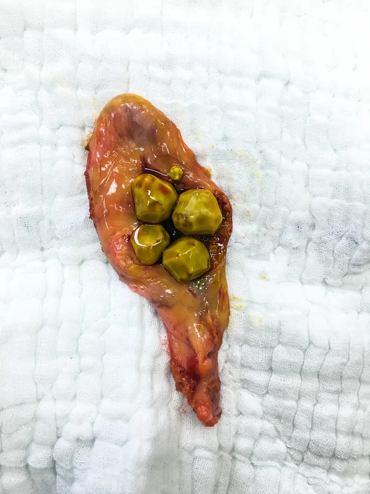 Gallbladder containing gallstones.