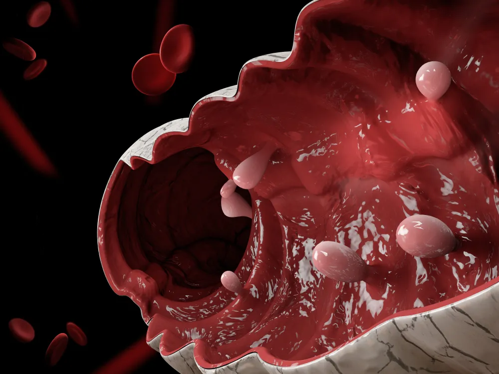 Colon Polyps 3d illustration.