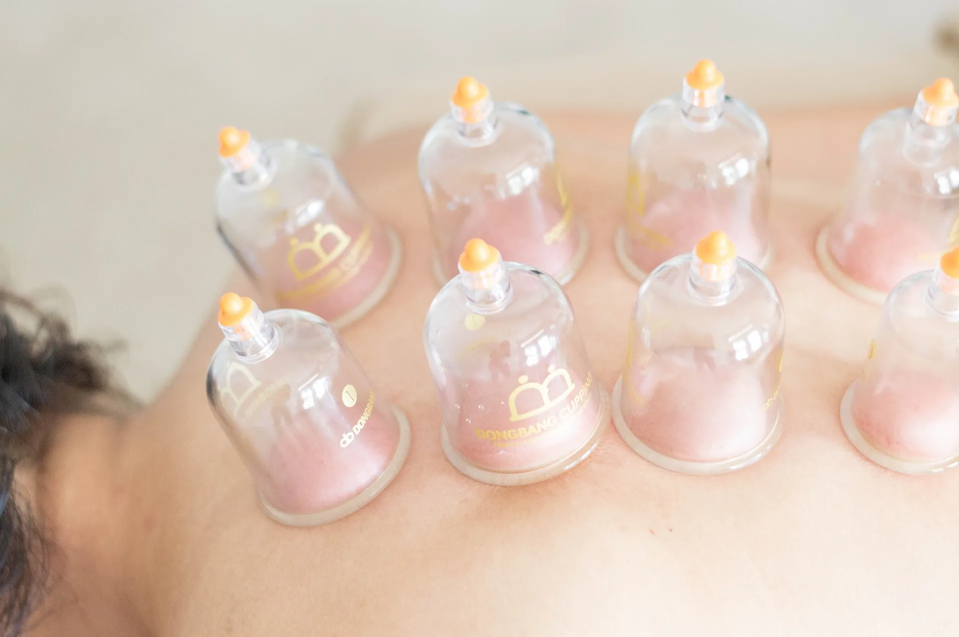 Cupping therapy. (Anti-inflammatory)