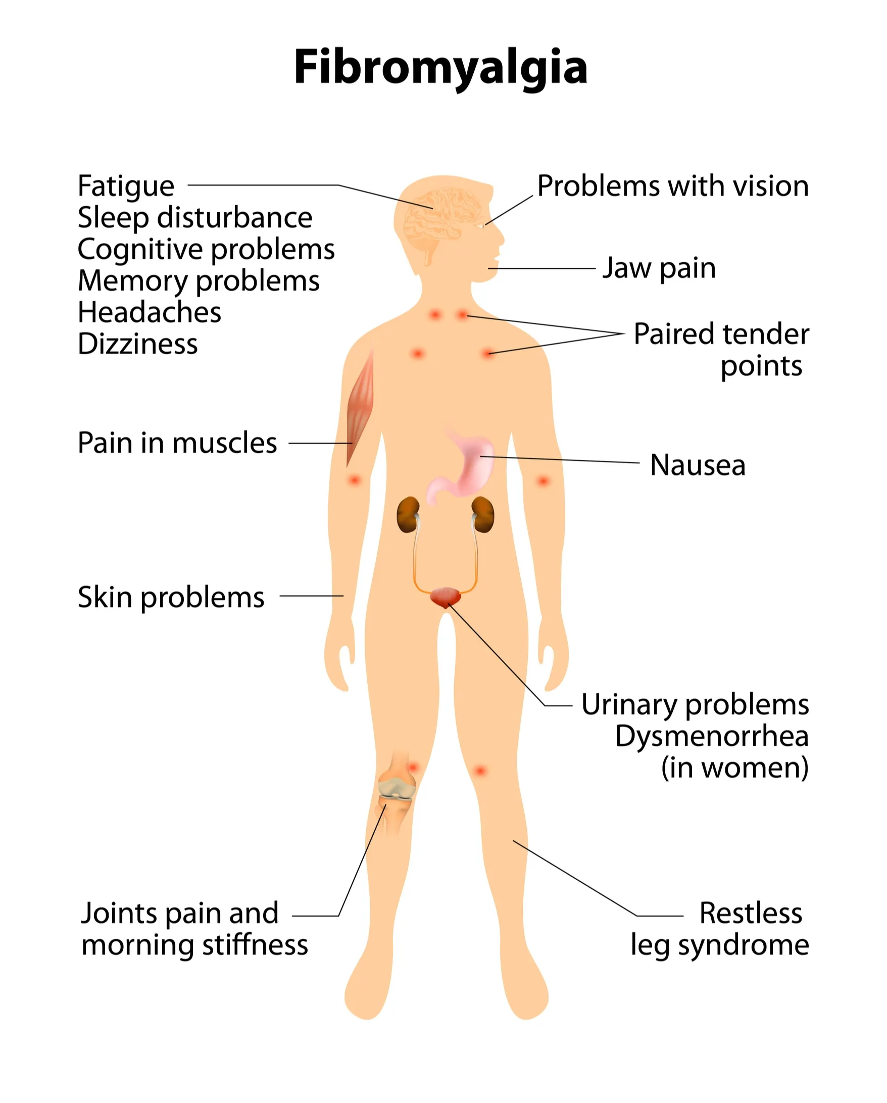 Fibromyalgia symptoms.