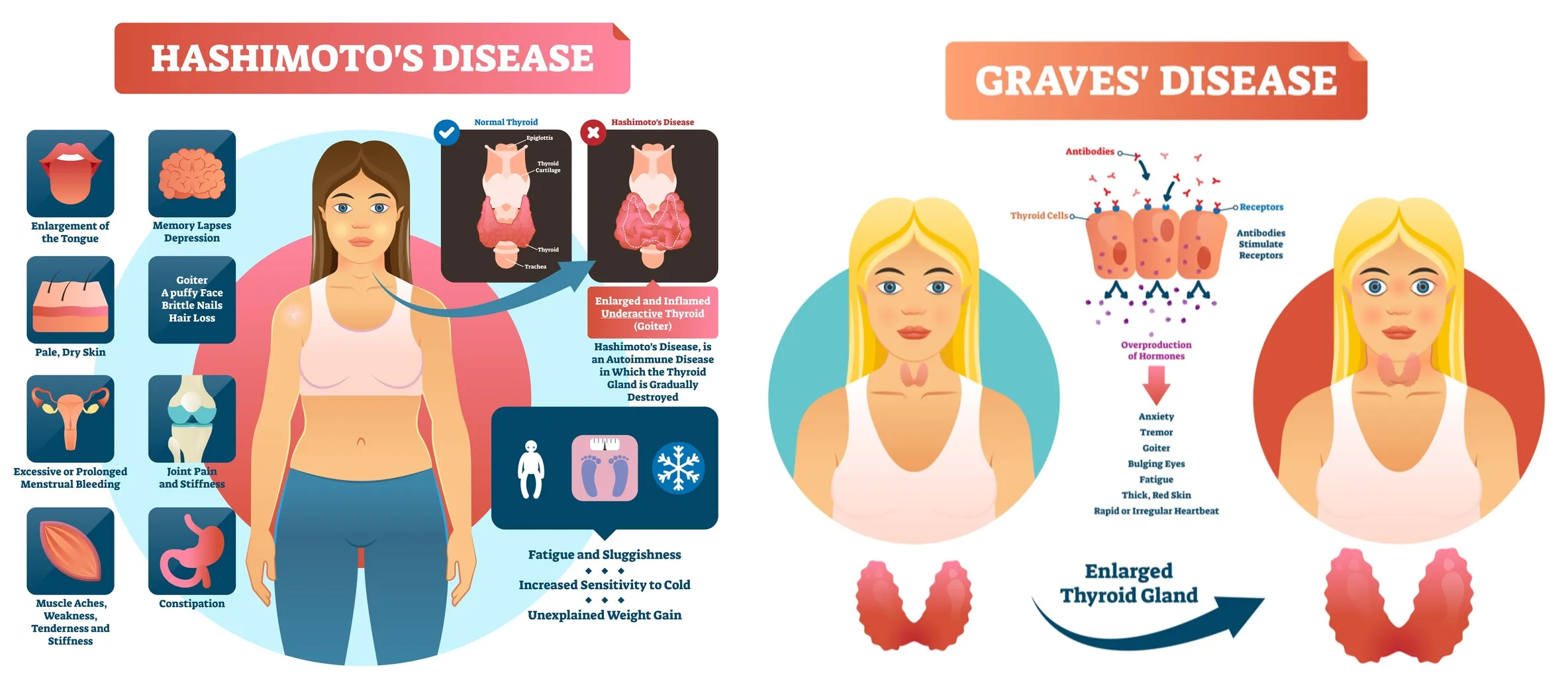 Hashimoto's thyroiditis and Graves' disease common symptoms.