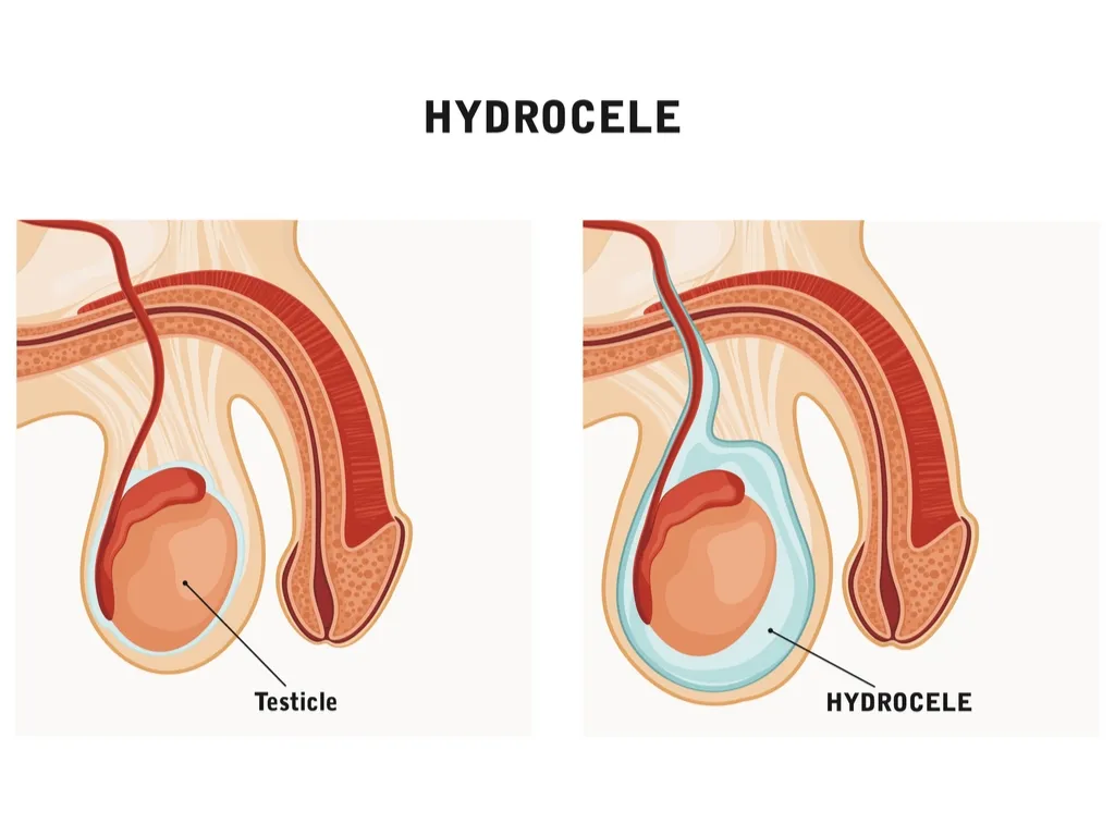 A hydrocele testis. (Accumulation of fluids around a testicle.)