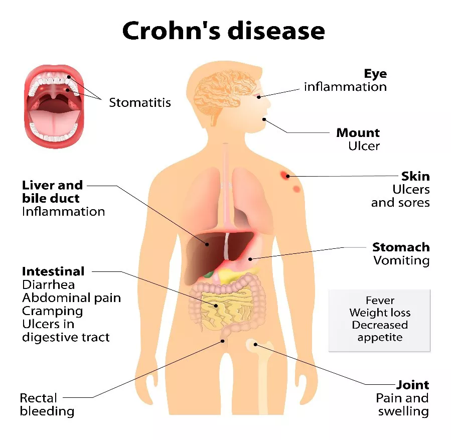 Crhon's disease common symptoms. 