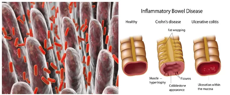 Intestines with good gut bacteria. Crohn's disease & Ulcerative colitis damages the intestinal wall.