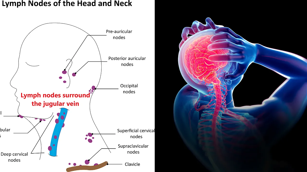 Intracranial pressure is the result of blockage of the jugular neck veins.