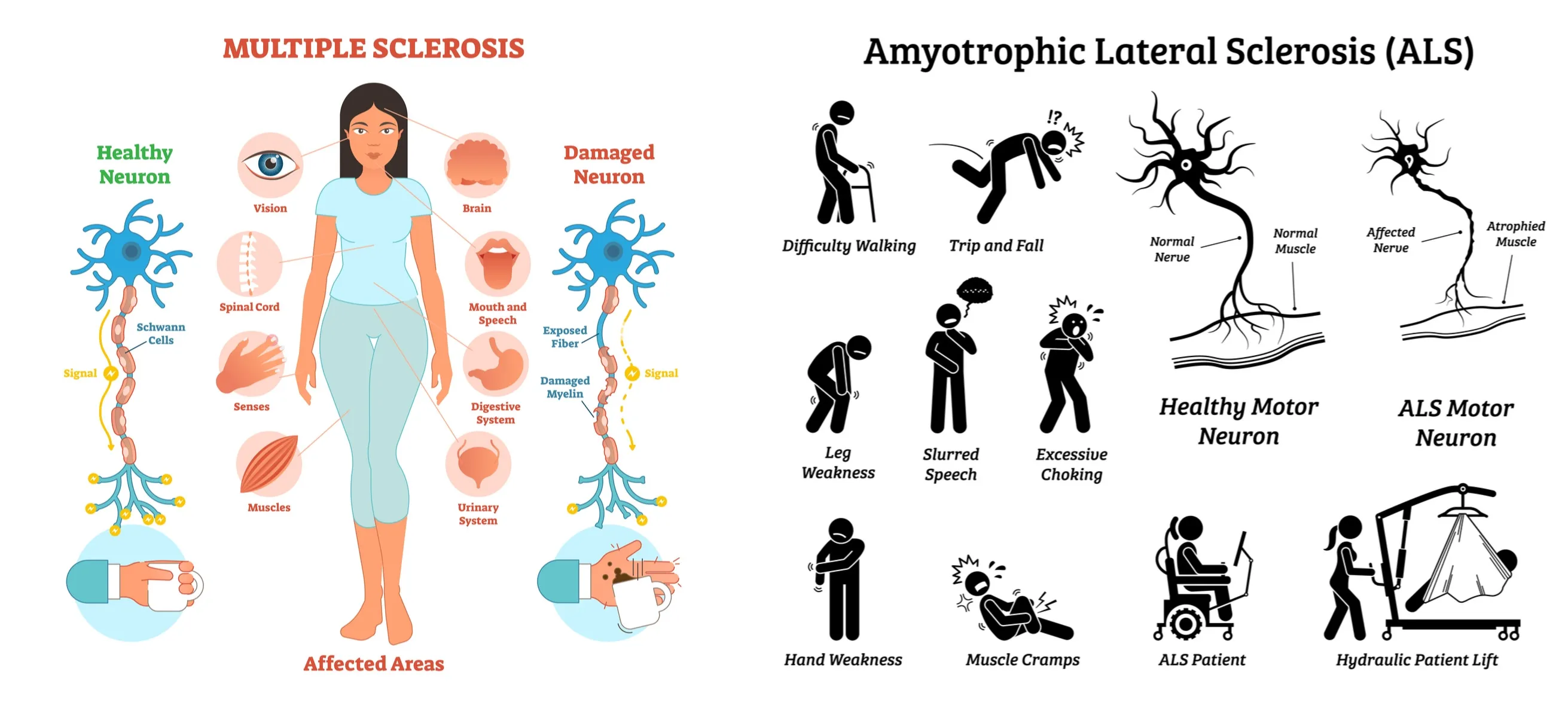 Multiple Sclerosis. (MS) & Amyotrophic Lateral Sclerosis. (ALS)