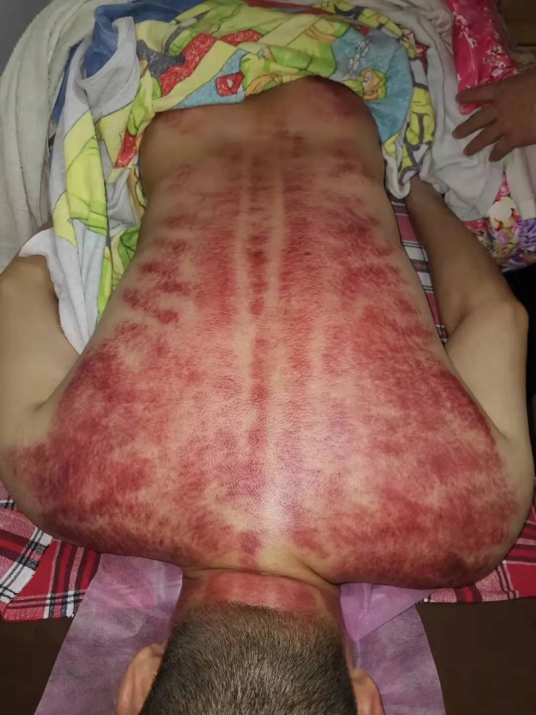 Scraping anti-inflammatory Therapy. (Authentic image from China)