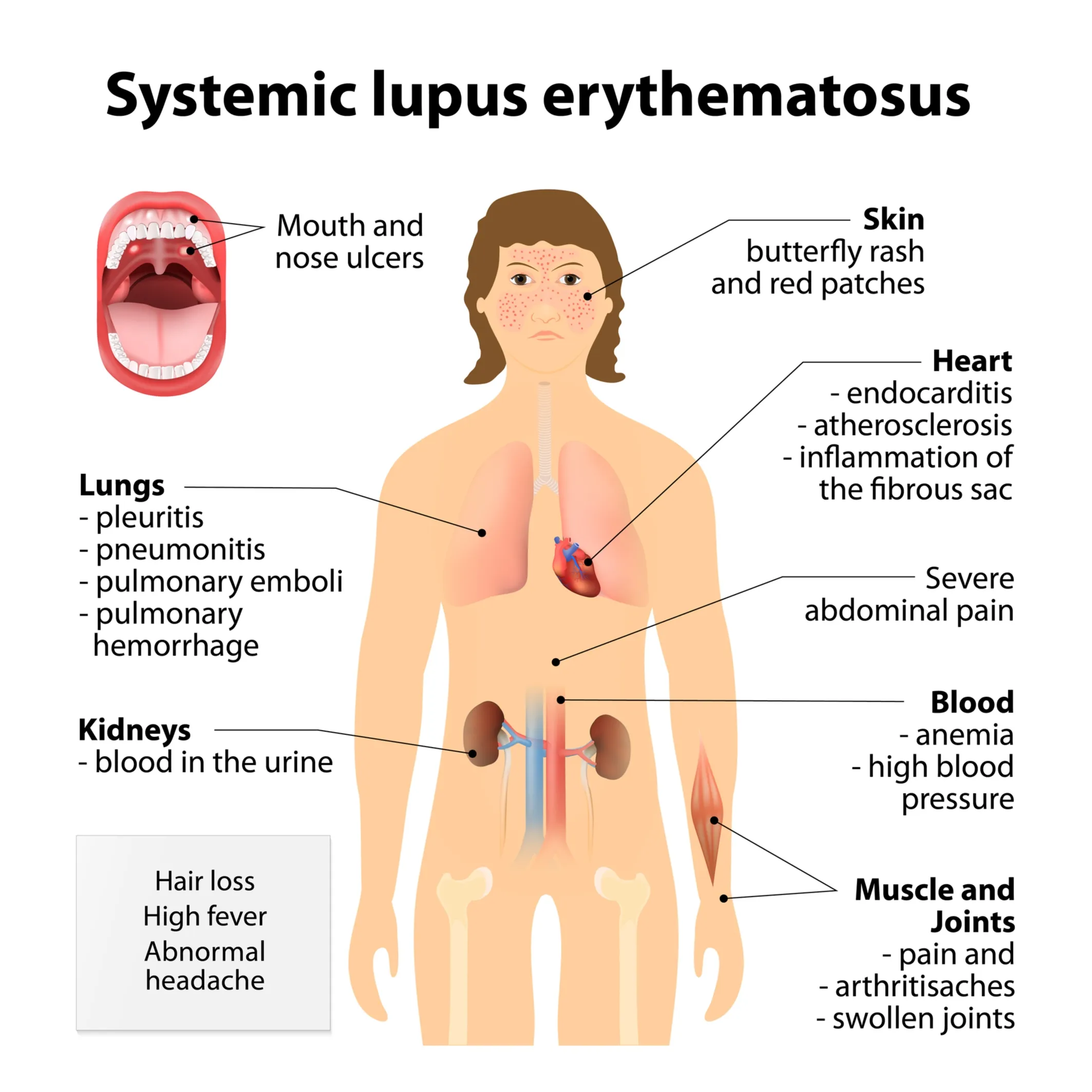 Systemic Lupus Erythematosus (SLE) symptoms. 